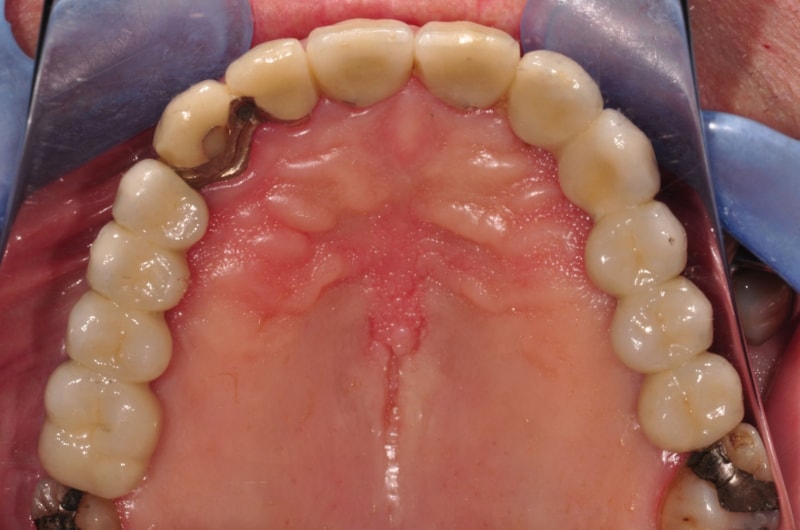Feste Zähne mit 8 Implantaten; aus Kostengründen wurden zwei alte Kronen mit dem Goldrand belassen